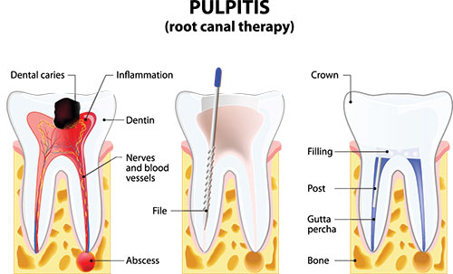 Today s Dental of Boxborough | Pediatric Dentistry, Dental Crowns and Night Guards for TMJ