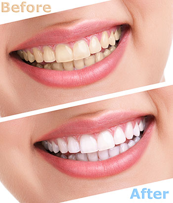 Teeth Whitening in Acton